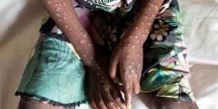 Mpox case patient